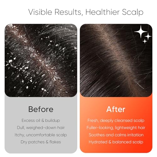 EKZ Sonic Vibrating Scalp Massager Shampoo Brush – Electric Silicone Hair Scrubber for Deep Scalp Cleansing, Dandruff Removal, Rich Foam & Relaxing Massage, Wet & Dry Use, USB-C Charging